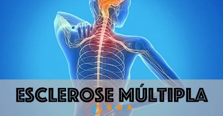 Avaré terá o primeiro evento sobre Esclerose Múltipla nesta quinta-feira (29)
